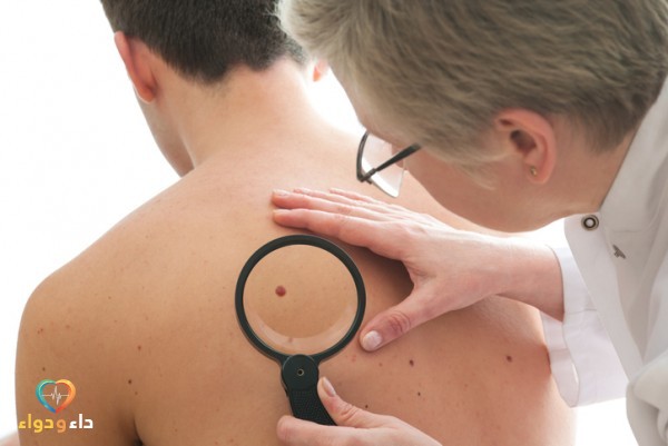 اعراض سرطان الجلد المبكرة