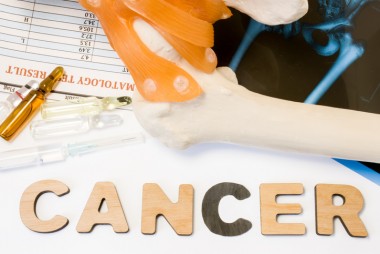 اعراض سرطان العظم المبكرة وأنواعه